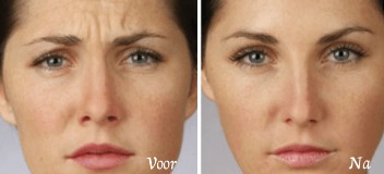 fronsrimpel dreamclinics