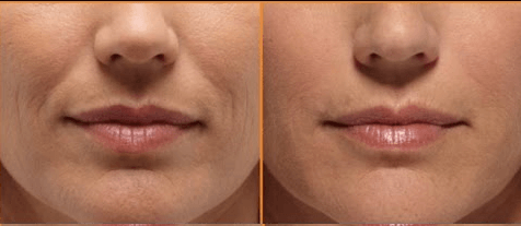 lachrimpels dreamclinics