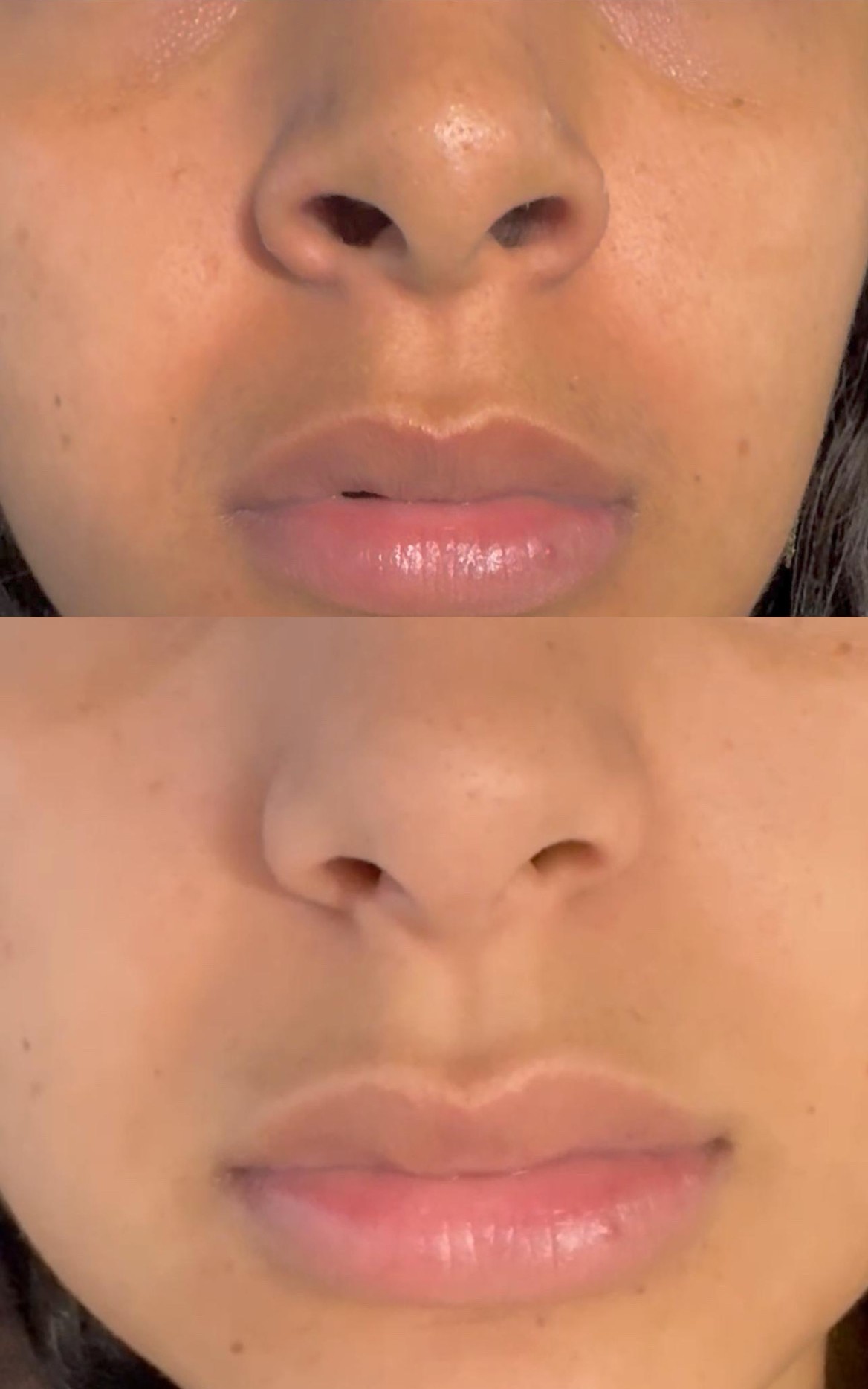 fronsrimpel dreamclinics